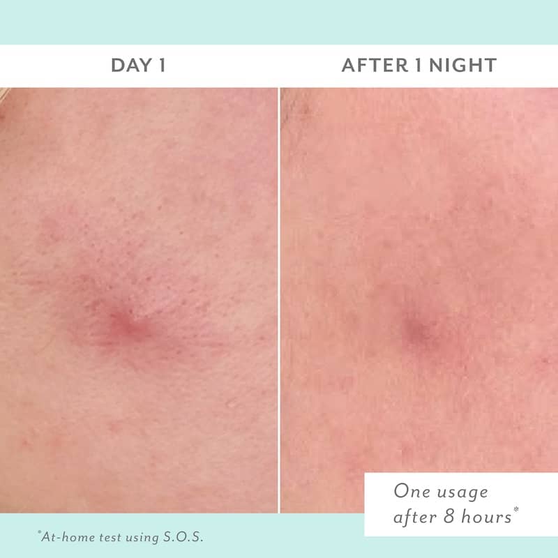 Before and after comparison of skin treatment showing a red spot on Day 1 and improved skin texture after 1 night.