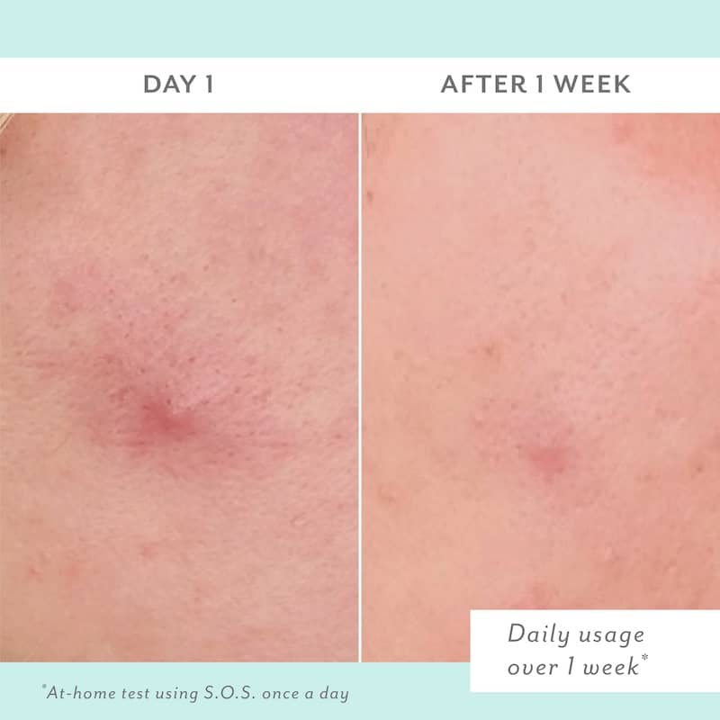 Before and after comparison of skin treatment on Day 1 and After 1 Week with a light blue background.
