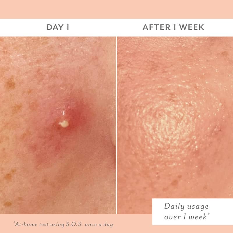 Before and after comparison of skin treatment on Day 1 and After 1 Week.