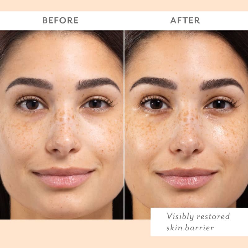 before and after skin remedy woman with brighter and less red skin visibly restored skin barrier
