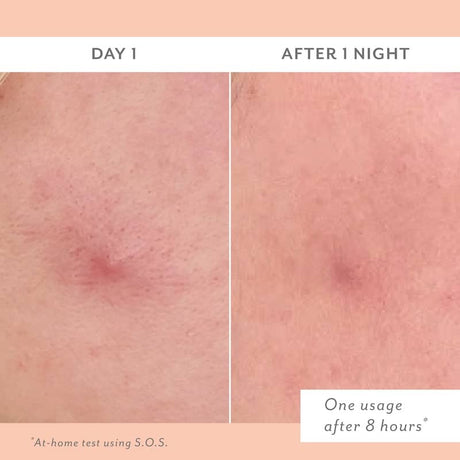 Before and after comparison of skin treatment on Day 1 and After 1 Night.