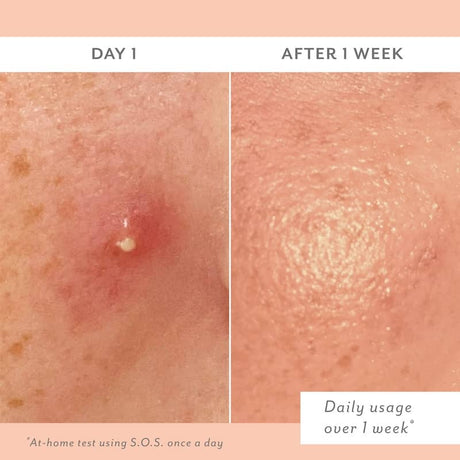 Before and after comparison of skin treatment on Day 1 and After 1 Week.